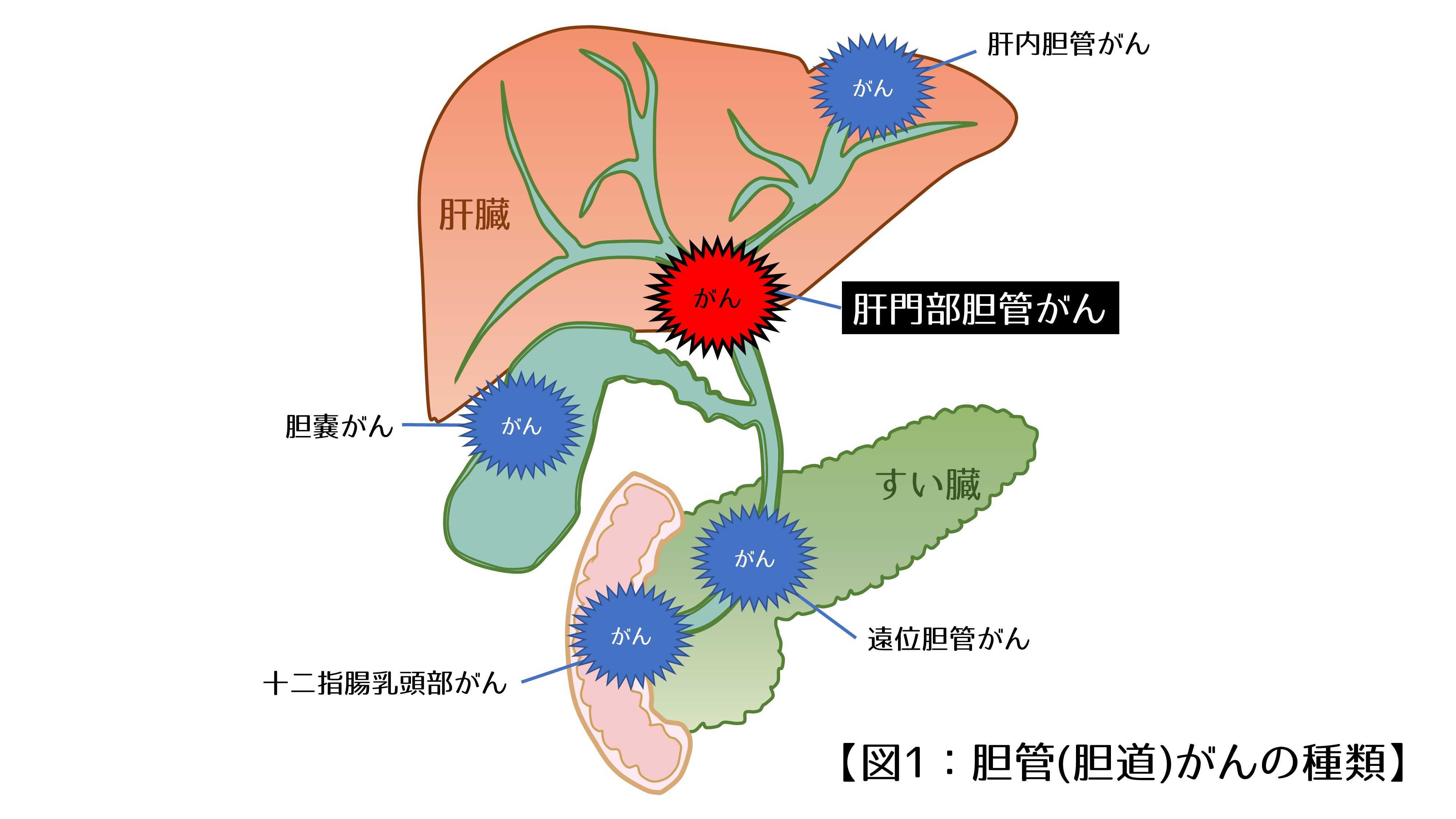 図1.胆管(胆道)がんの種類｜肝門部胆管がん