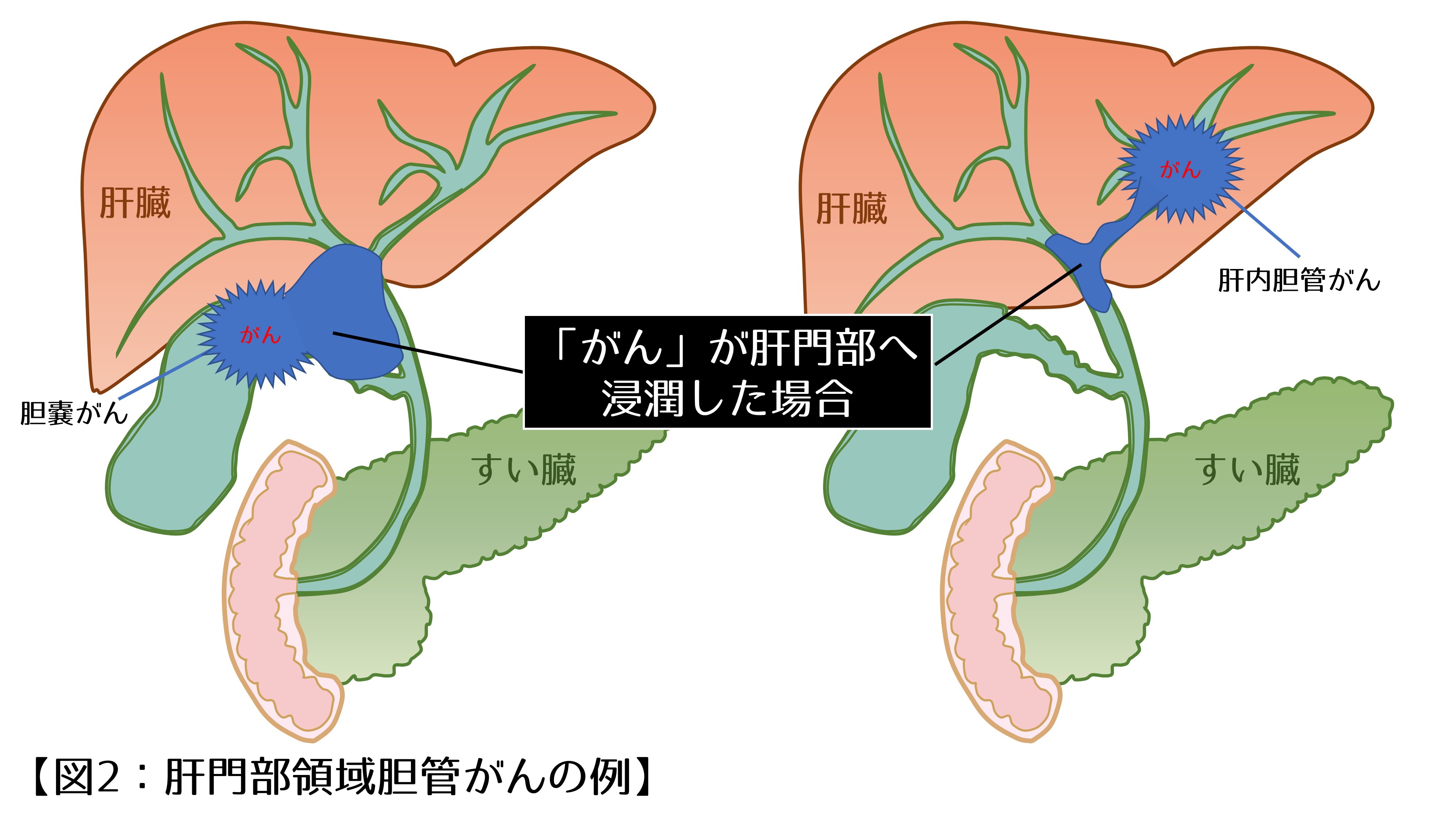 図2.肝門部領域胆管がんの例｜肝門部胆管がん
