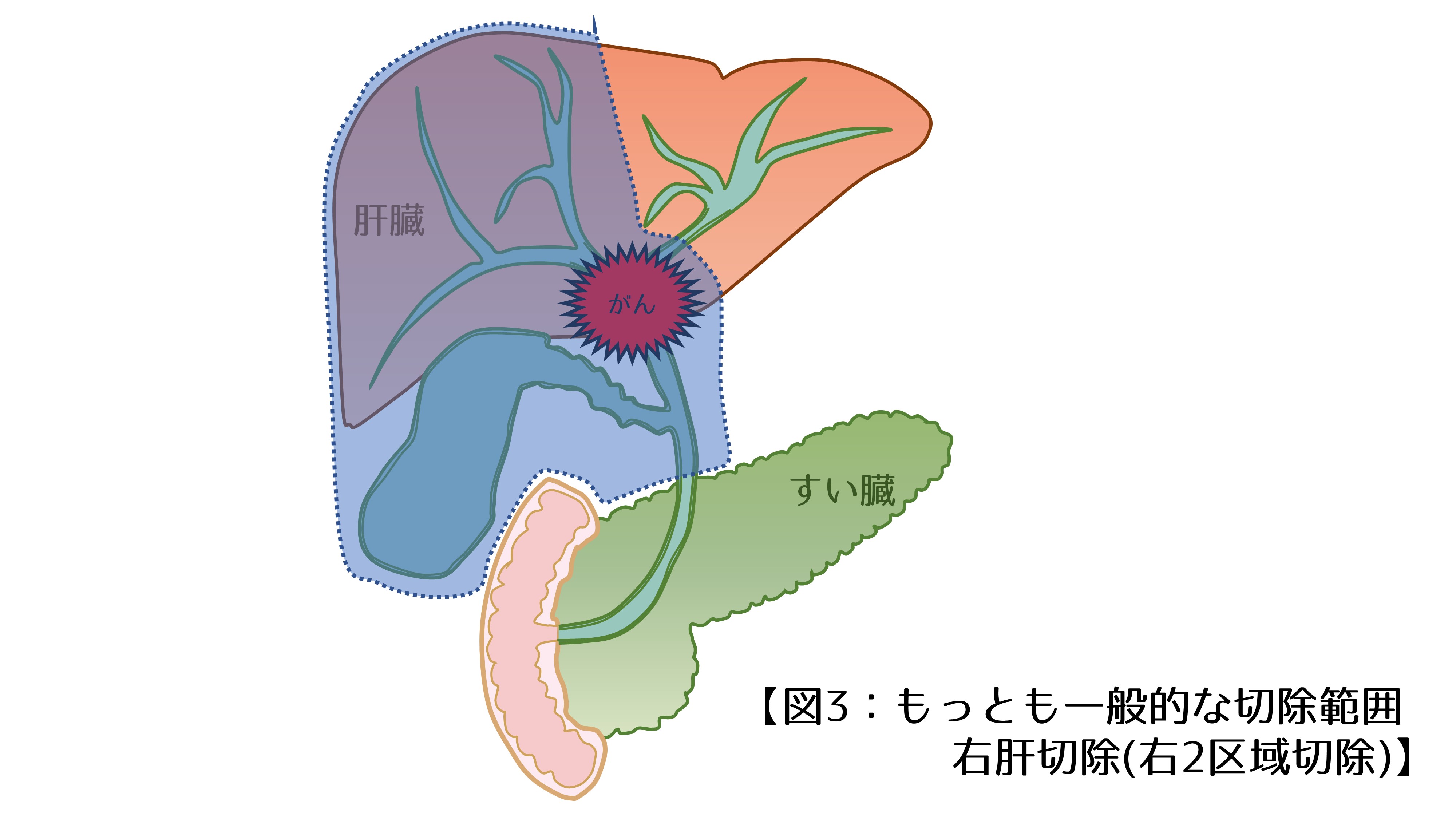 図3.もっとも一般的な切除範囲－右肝切除(右2区域切除)｜肝門部胆管がん