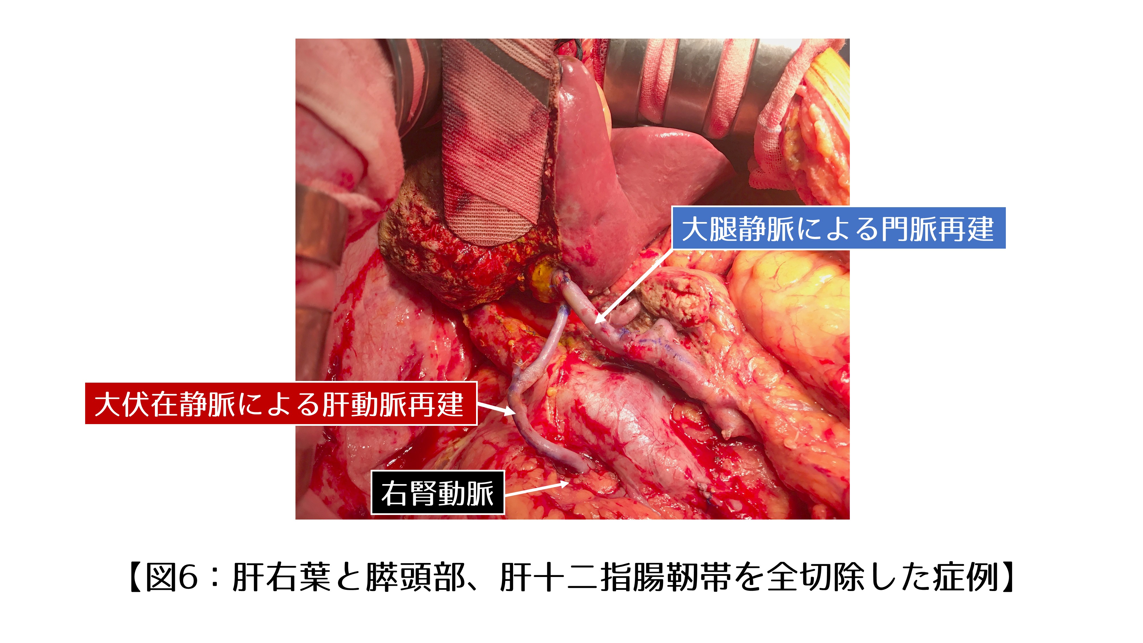 図6.肝右葉と膵頭部、肝十二指腸靭帯を全切除した症例｜肝門部胆管がん